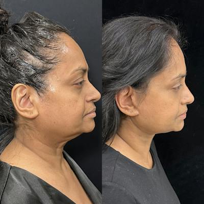Deep Plane Facelift Before & After Gallery - Patient 322272 - Image 3