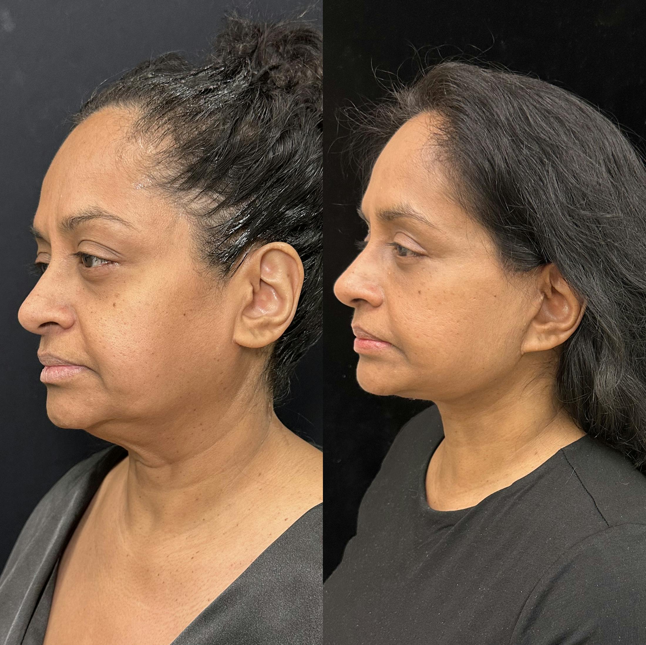 Deep Plane Facelift Before & After Gallery - Patient 322272 - Image 4
