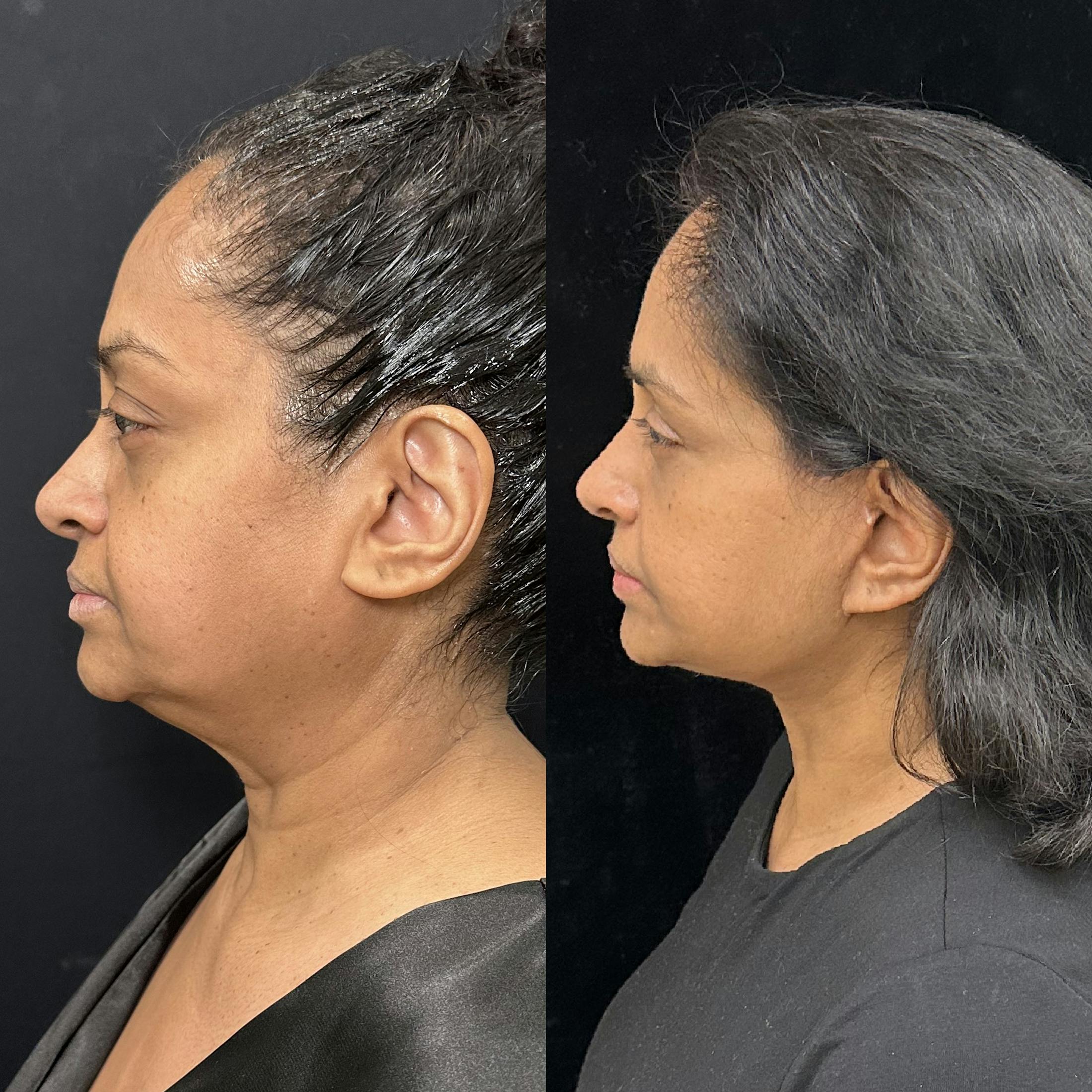 Deep Plane Facelift Before & After Gallery - Patient 322272 - Image 5