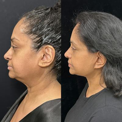 Deep Plane Facelift Before & After Gallery - Patient 322272 - Image 5