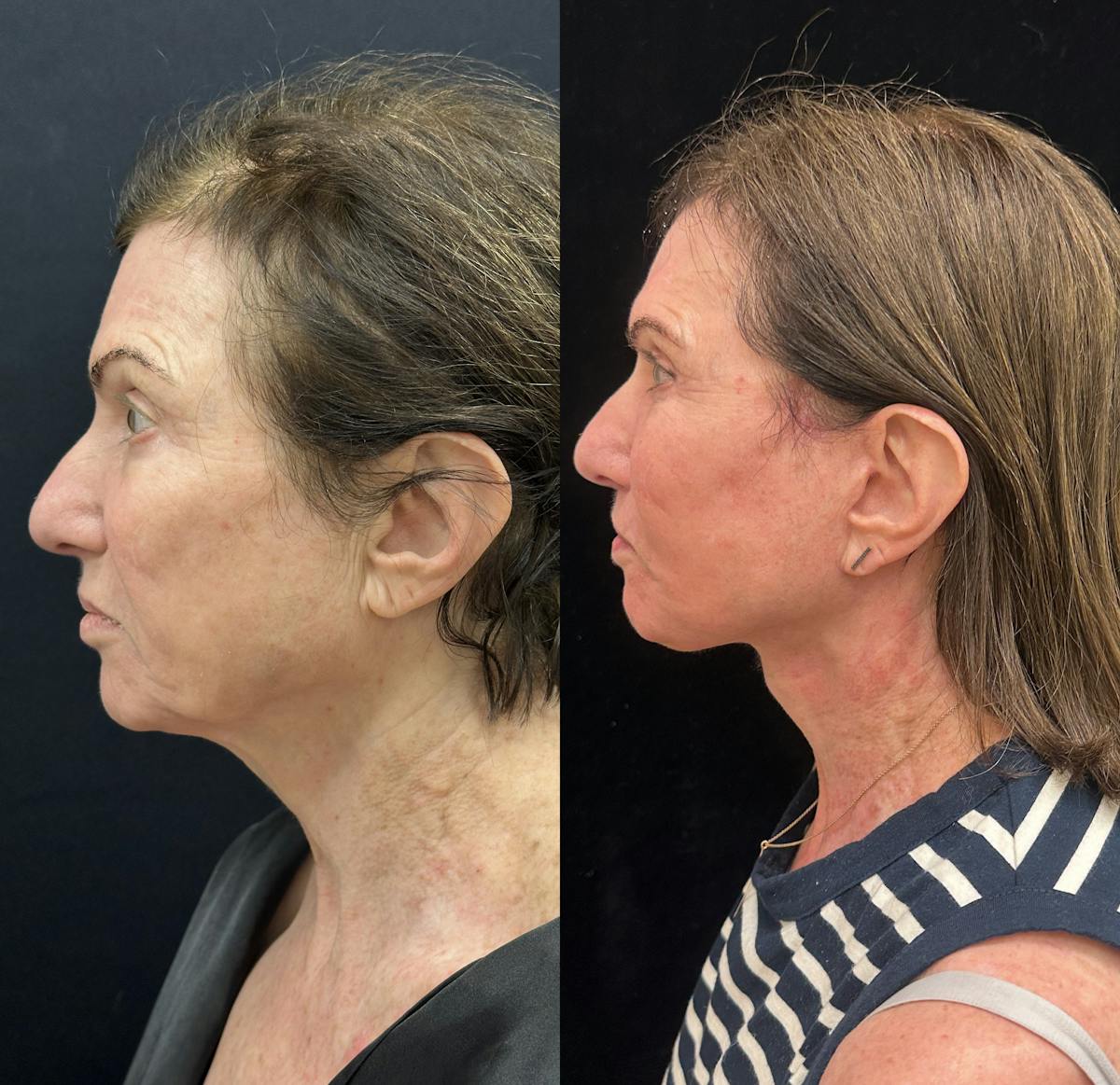 Deep Plane Facelift Before & After Gallery - Patient 164866 - Image 5