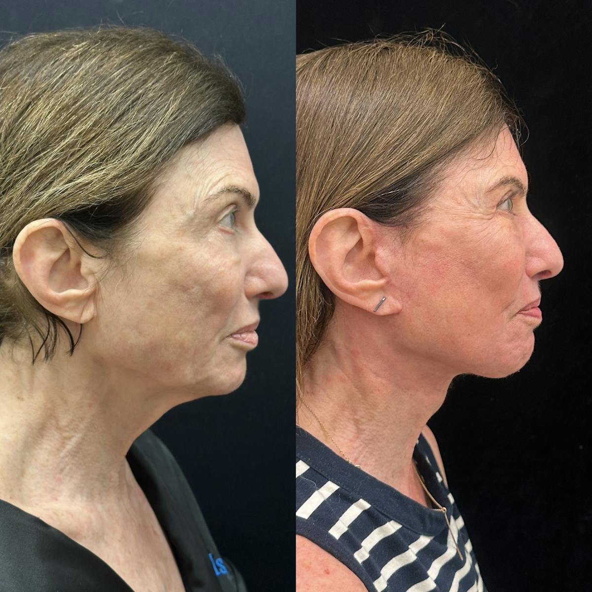 Deep Plane Facelift Before & After Gallery - Patient 164866 - Image 2