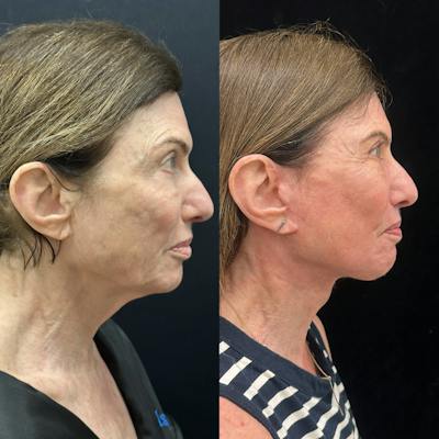 Deep Plane Facelift Before & After Gallery - Patient 164866 - Image 2