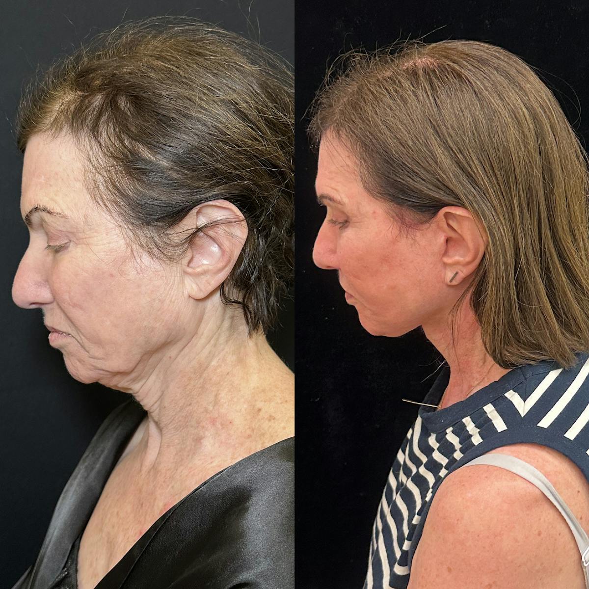 Deep Plane Facelift Before & After Gallery - Patient 164866 - Image 6