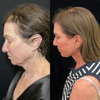 Deep Plane Facelift Before & After Gallery - Patient 164866 - Image 6
