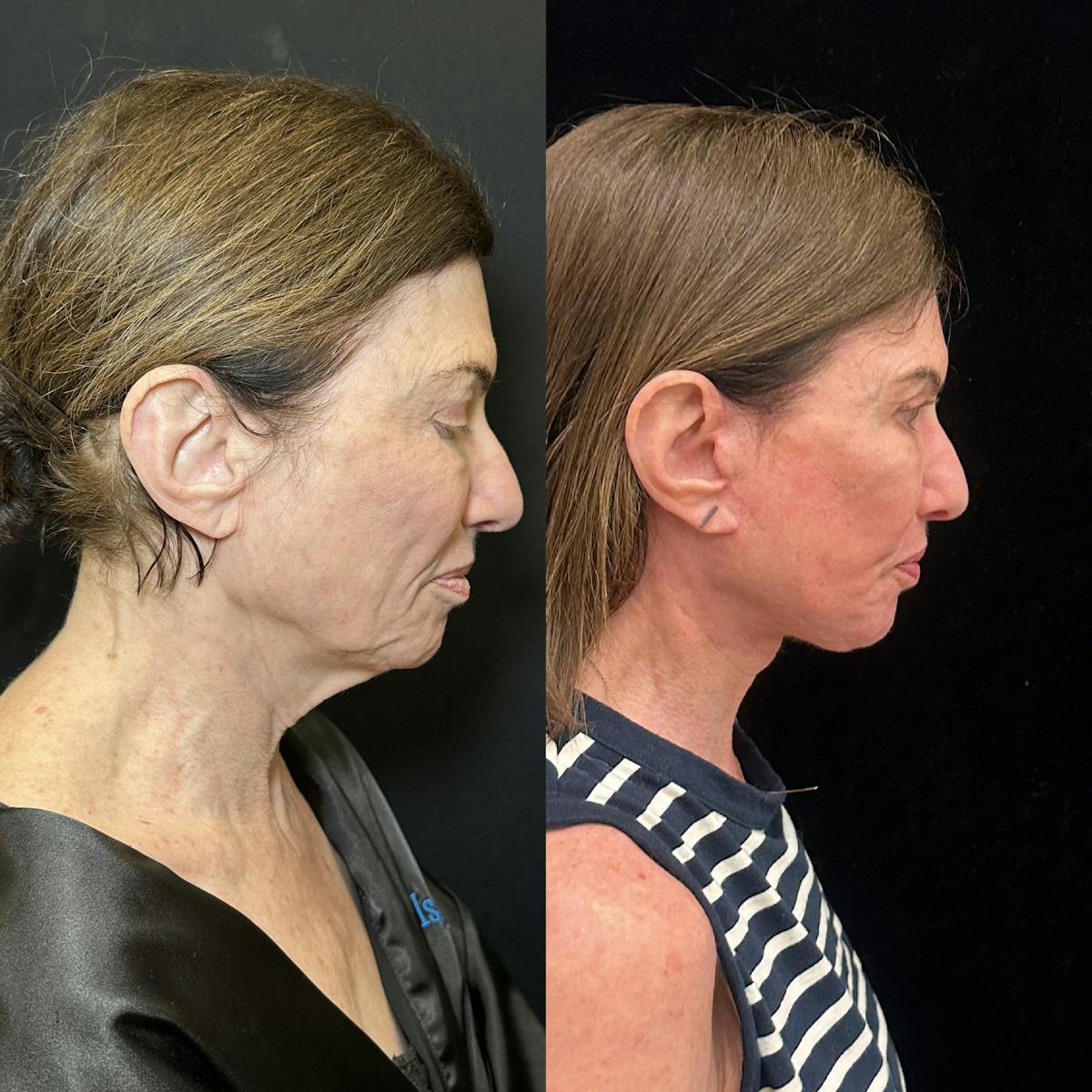 Deep Plane Facelift Before & After Gallery - Patient 164866 - Image 3