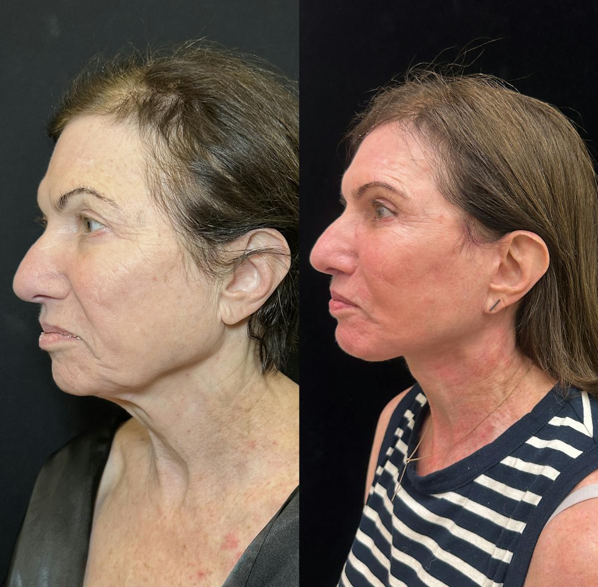 Deep Plane Facelift Before & After Gallery - Patient 164866 - Image 4
