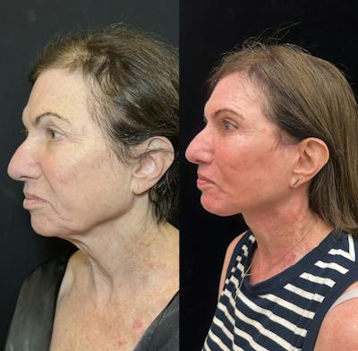 Deep Plane Facelift Before & After Gallery - Patient 164866 - Image 4