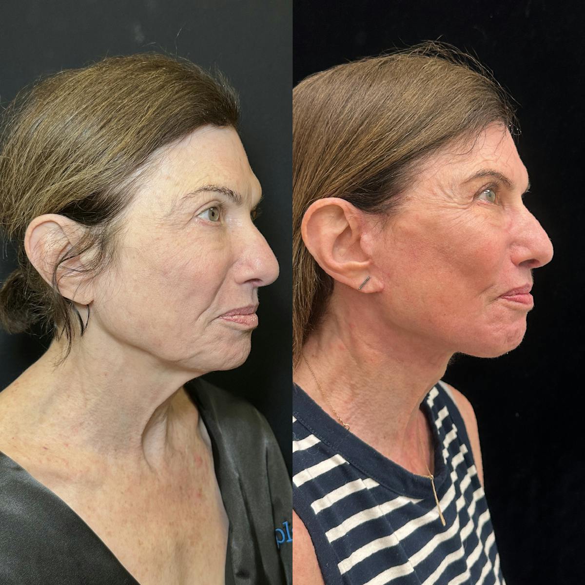 Deep Plane Facelift Before & After Gallery - Patient 164866 - Image 1