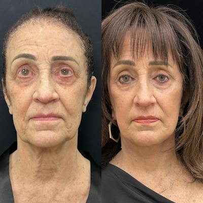 Deep Plane Facelift Before & After Gallery - Patient 323643 - Image 1