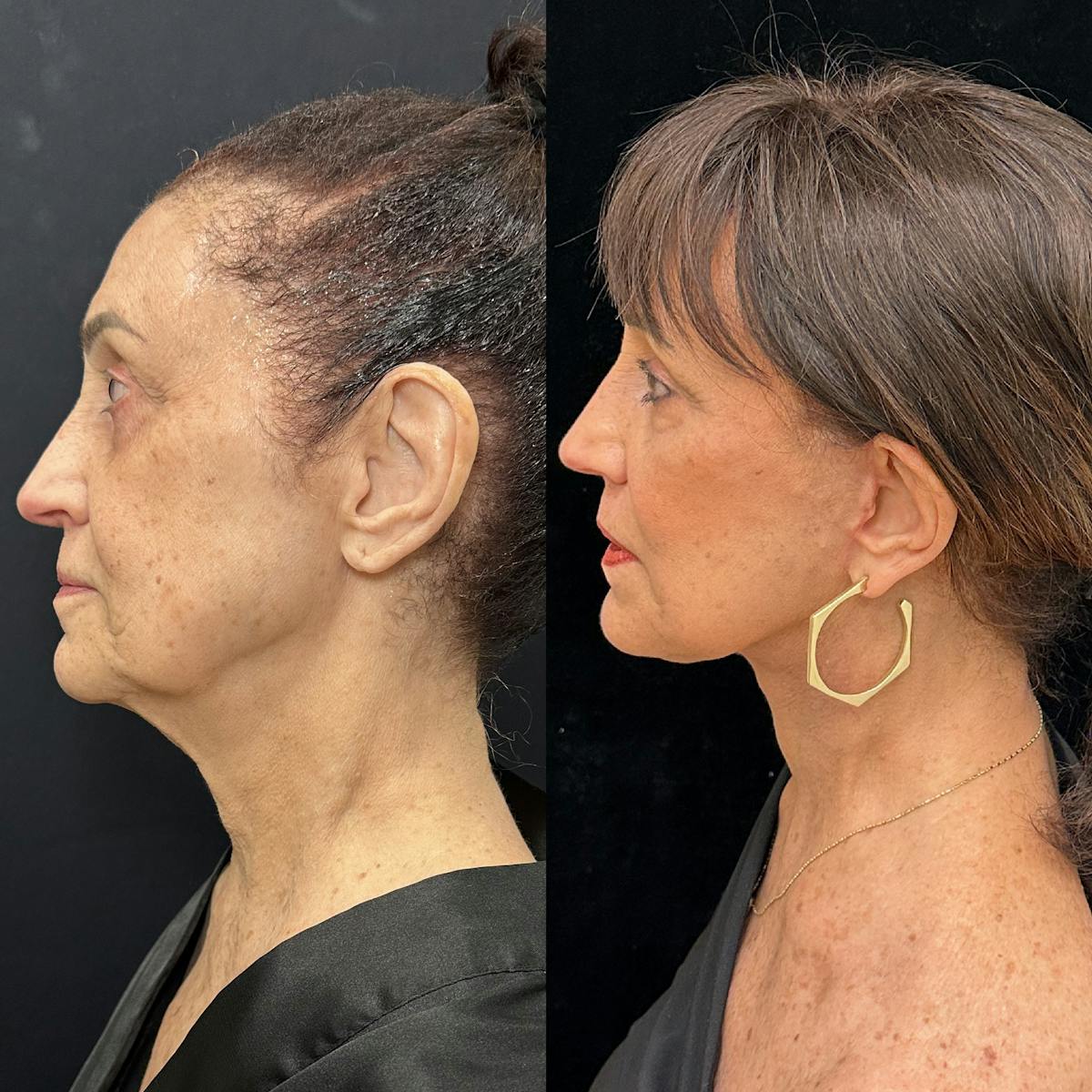 Deep Plane Facelift Before & After Gallery - Patient 323643 - Image 5
