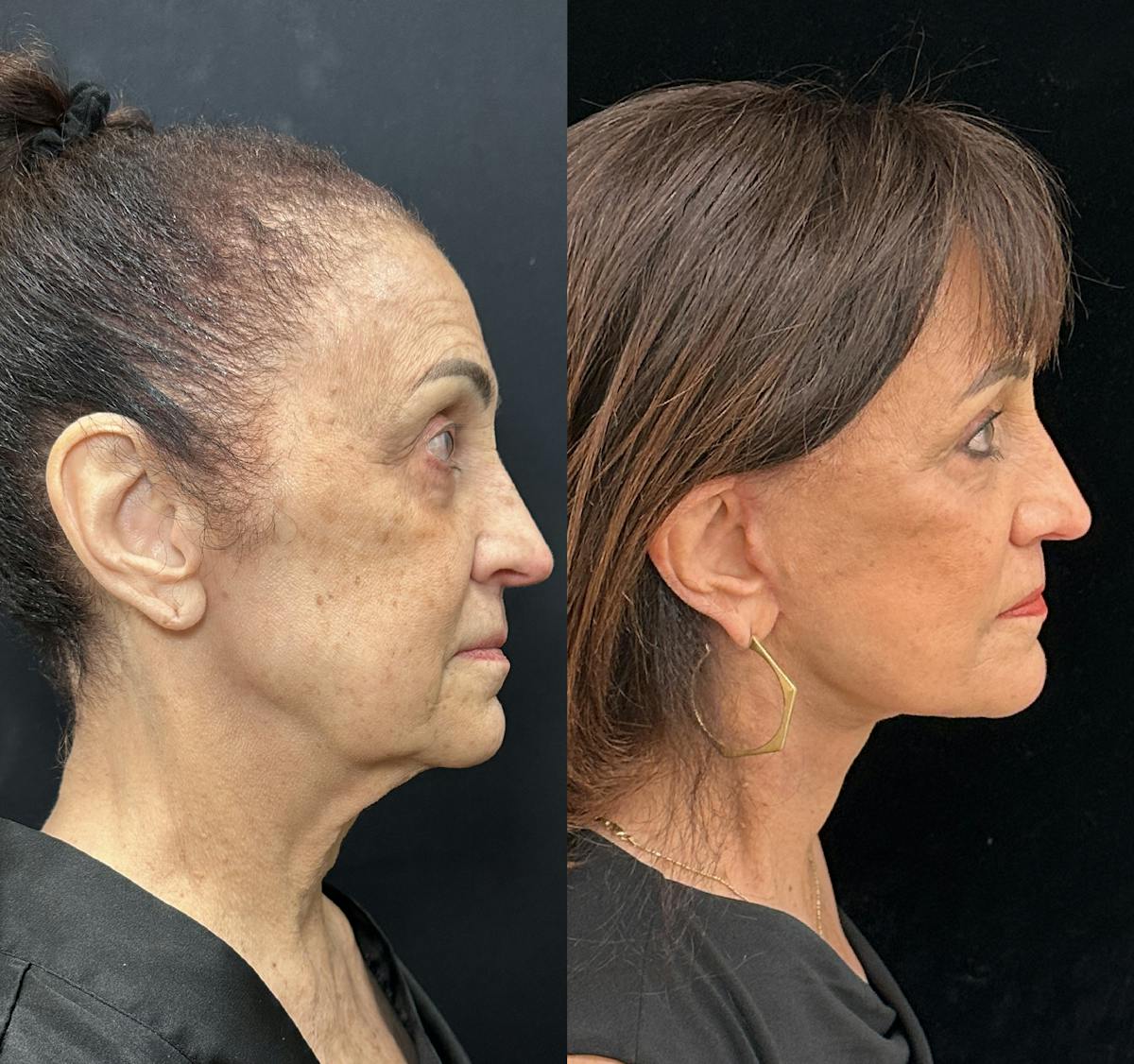 Deep Plane Facelift Before & After Gallery - Patient 323643 - Image 3