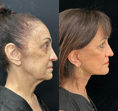 Deep Plane Facelift Before & After Gallery - Patient 323643 - Image 3