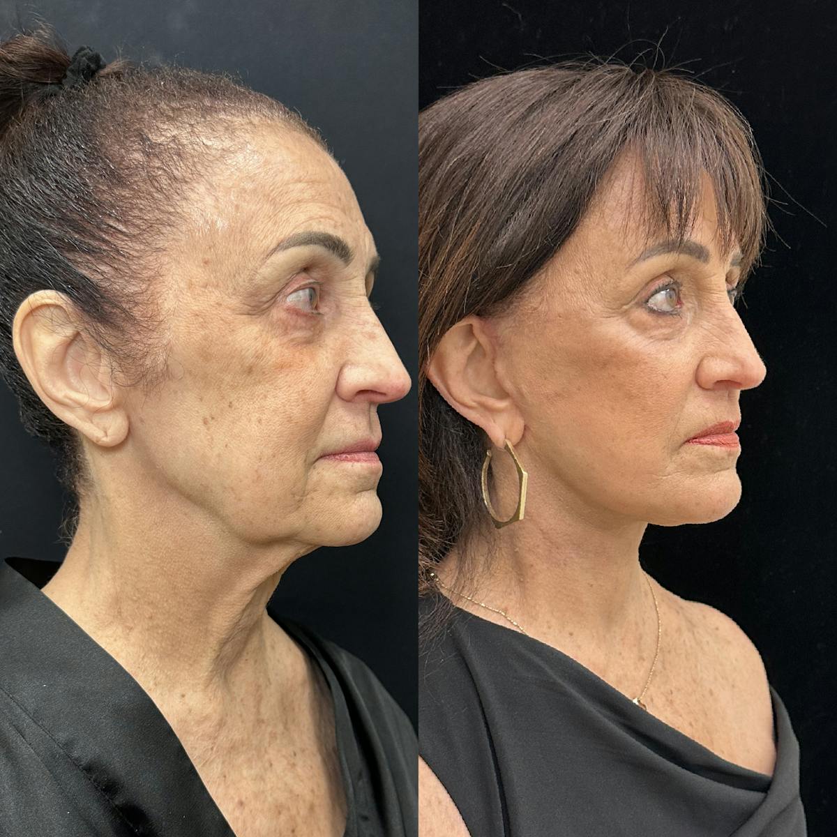 Deep Plane Facelift Before & After Gallery - Patient 323643 - Image 2