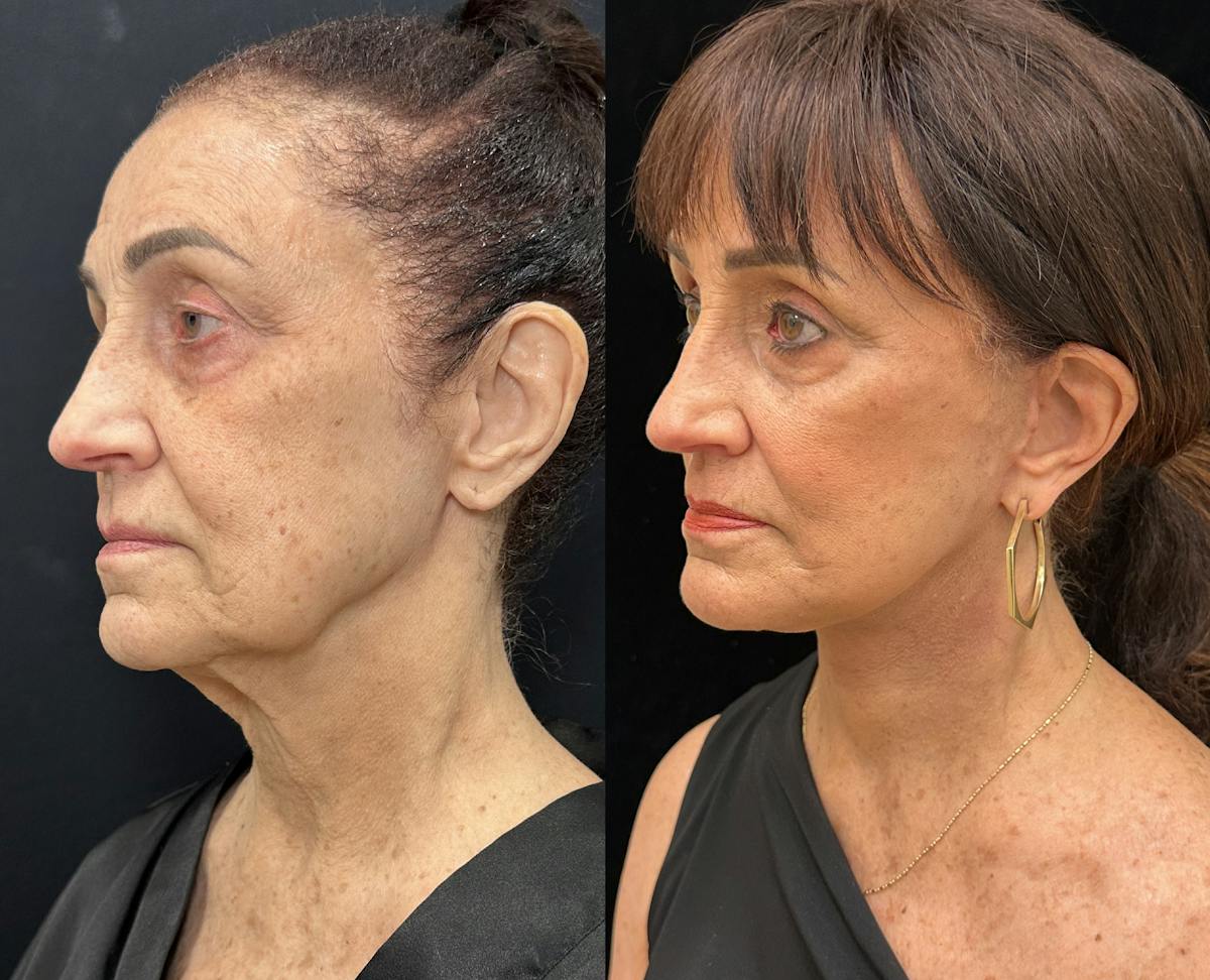 Deep Plane Facelift Before & After Gallery - Patient 323643 - Image 4