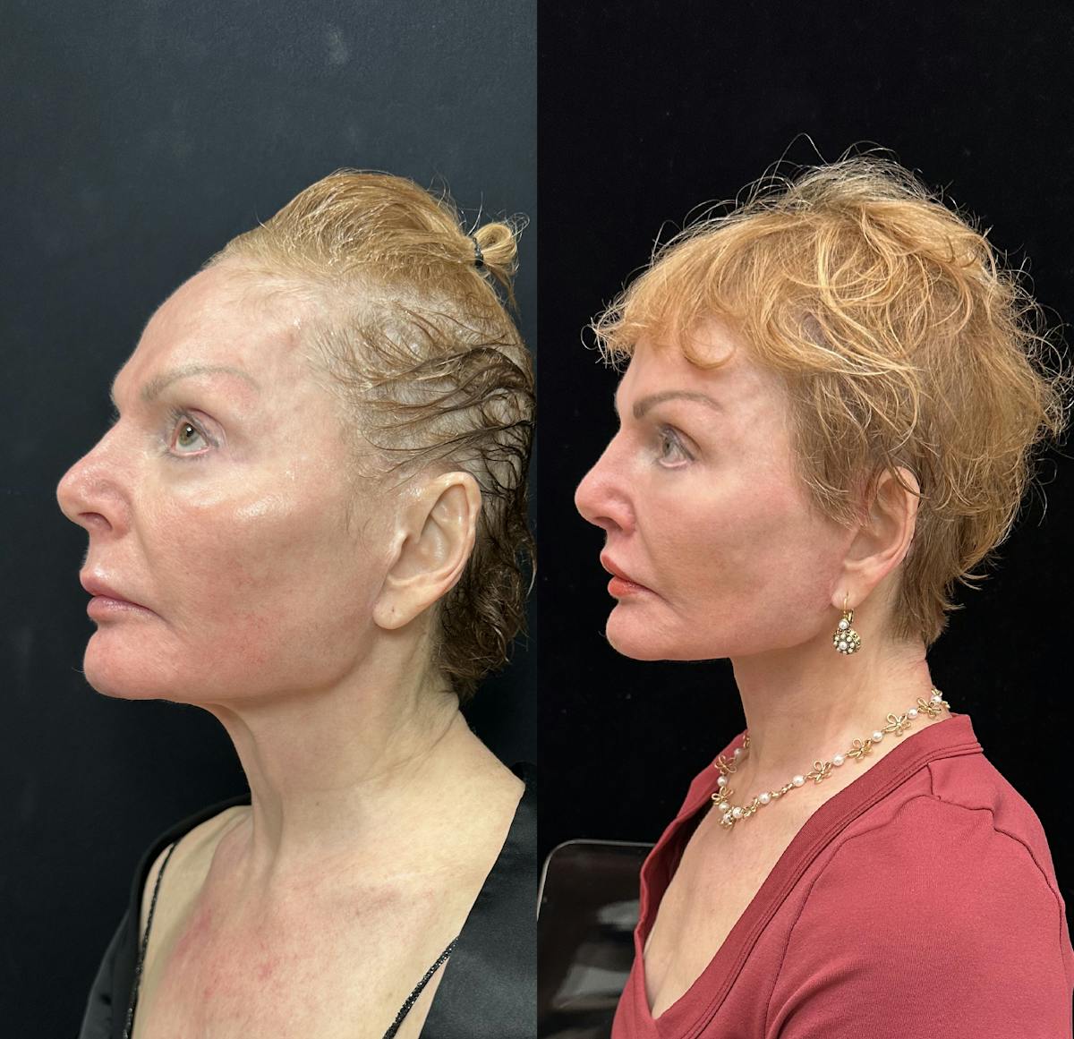 Deep Plane Facelift Before & After Gallery - Patient 344166 - Image 4