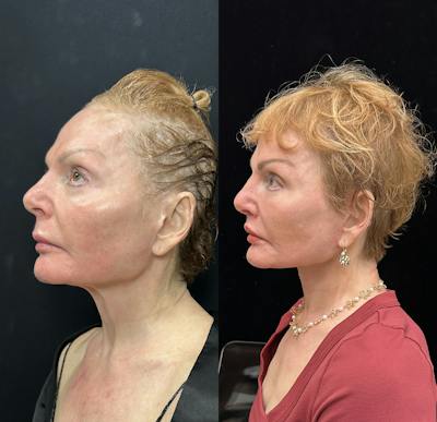 Deep Plane Facelift Before & After Gallery - Patient 344166 - Image 4