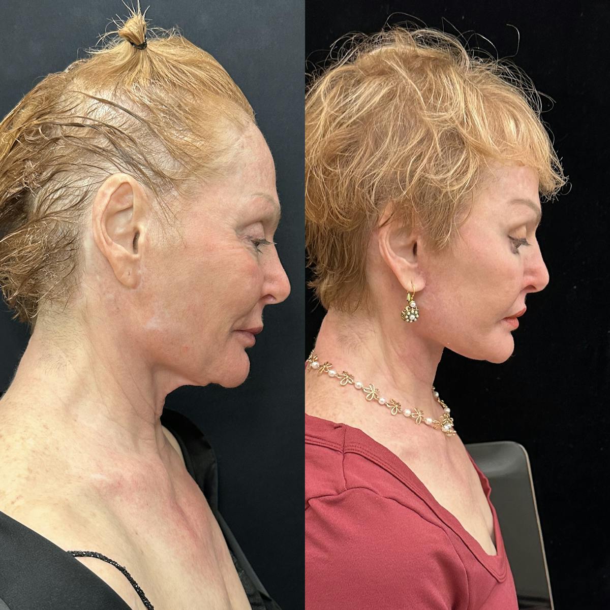 Deep Plane Facelift Before & After Gallery - Patient 344166 - Image 3