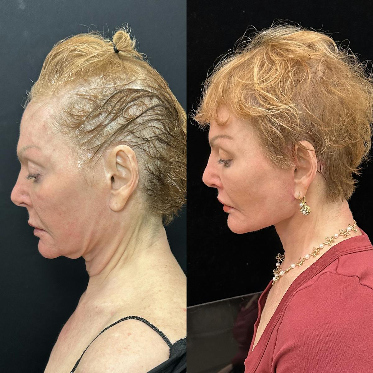 Deep Plane Facelift Before & After Gallery - Patient 344166 - Image 6