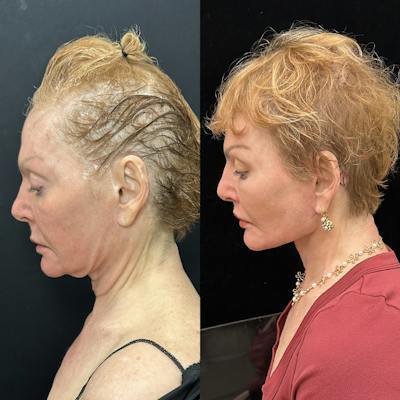 Deep Plane Facelift Before & After Gallery - Patient 344166 - Image 6