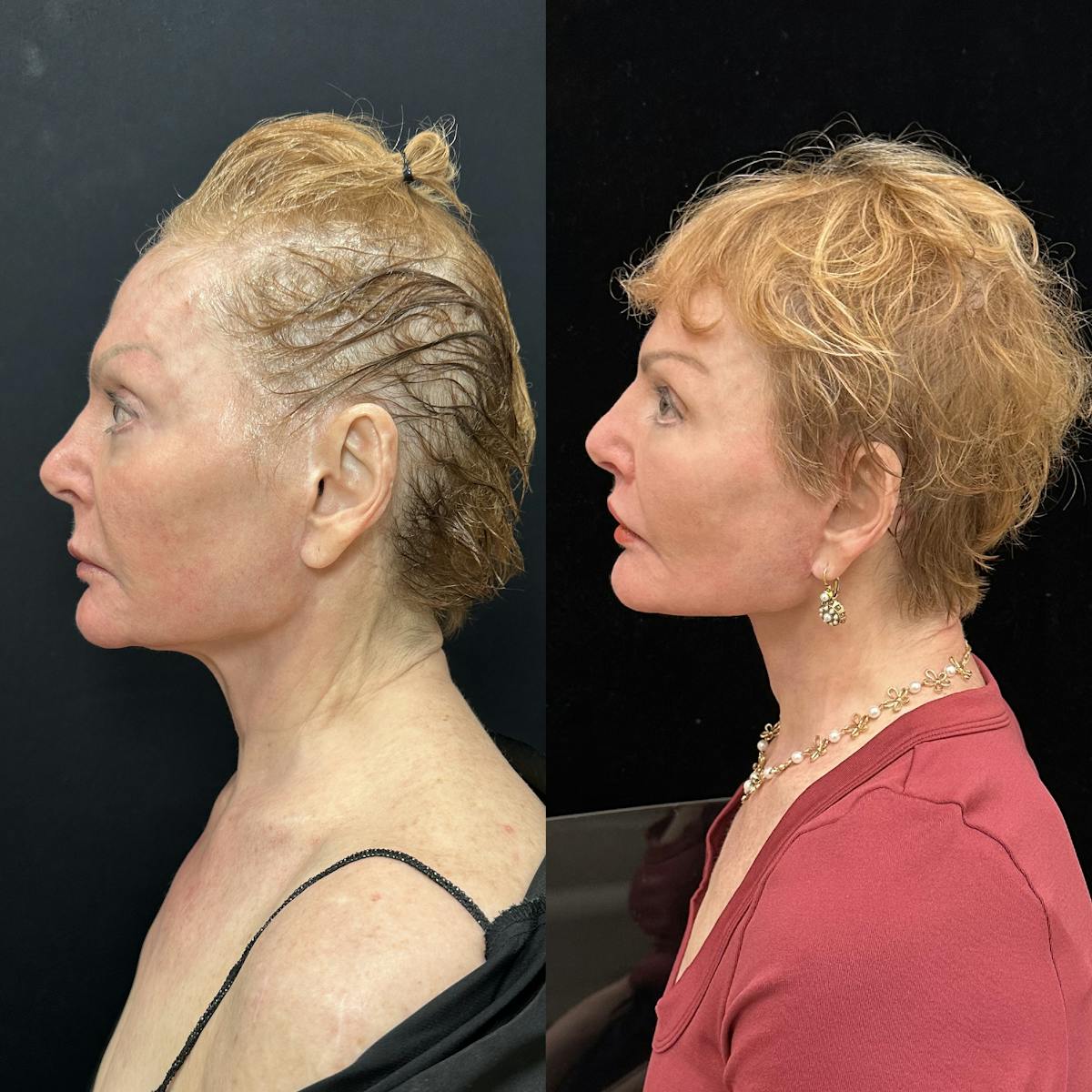 Deep Plane Facelift Before & After Gallery - Patient 344166 - Image 5