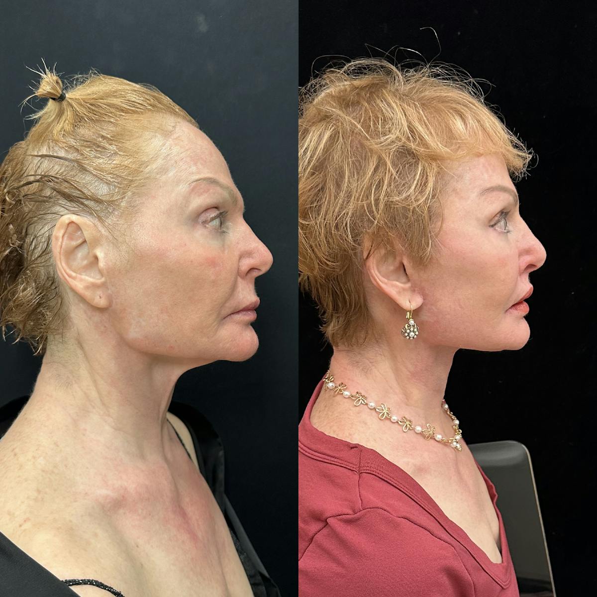 Deep Plane Facelift Before & After Gallery - Patient 344166 - Image 2