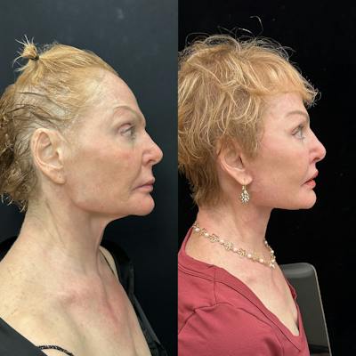 Deep Plane Facelift Before & After Gallery - Patient 344166 - Image 2