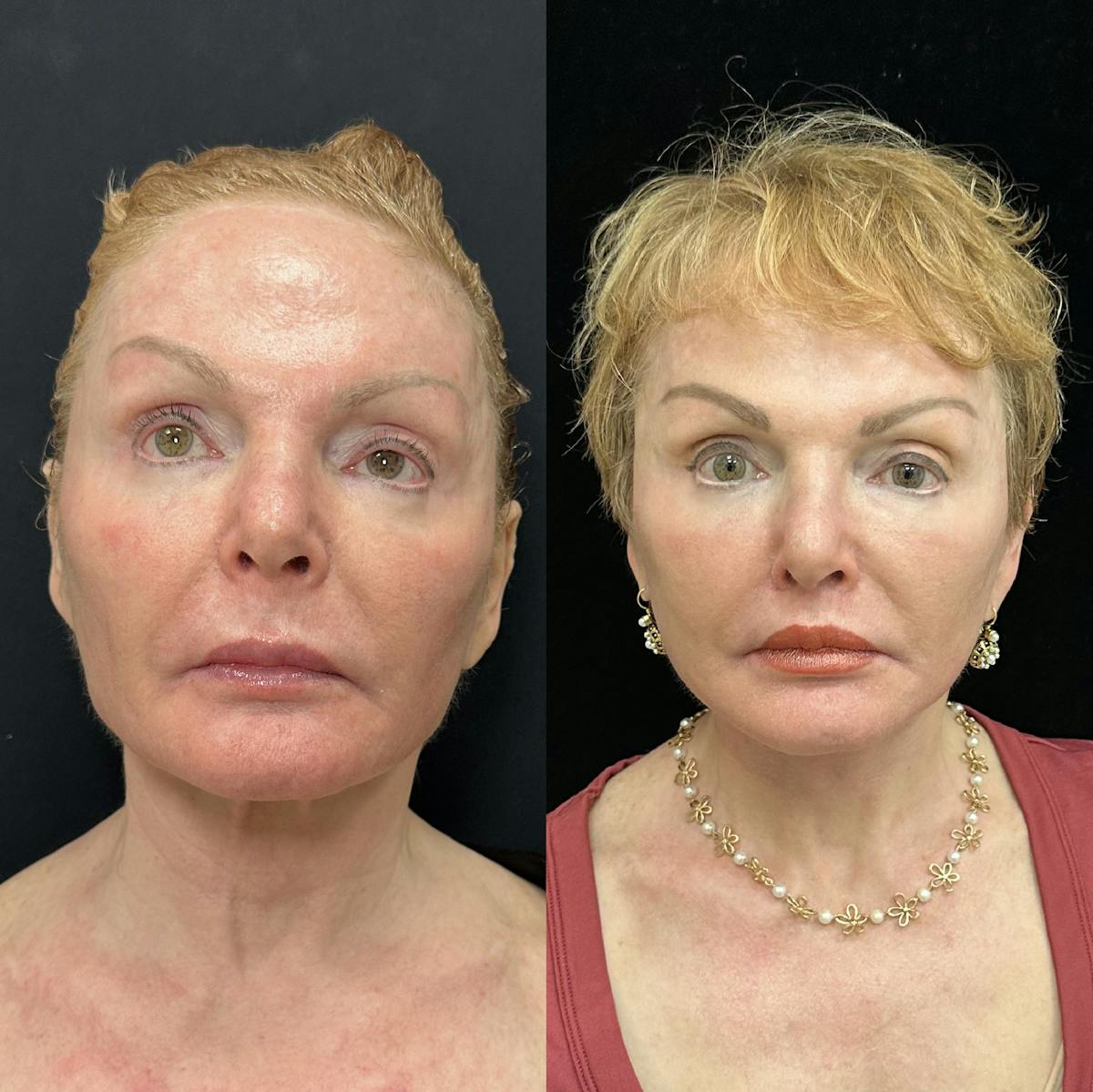 Deep Plane Facelift Before & After Gallery - Patient 344166 - Image 1