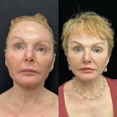 Deep Plane Facelift Before & After Gallery - Patient 344166 - Image 1