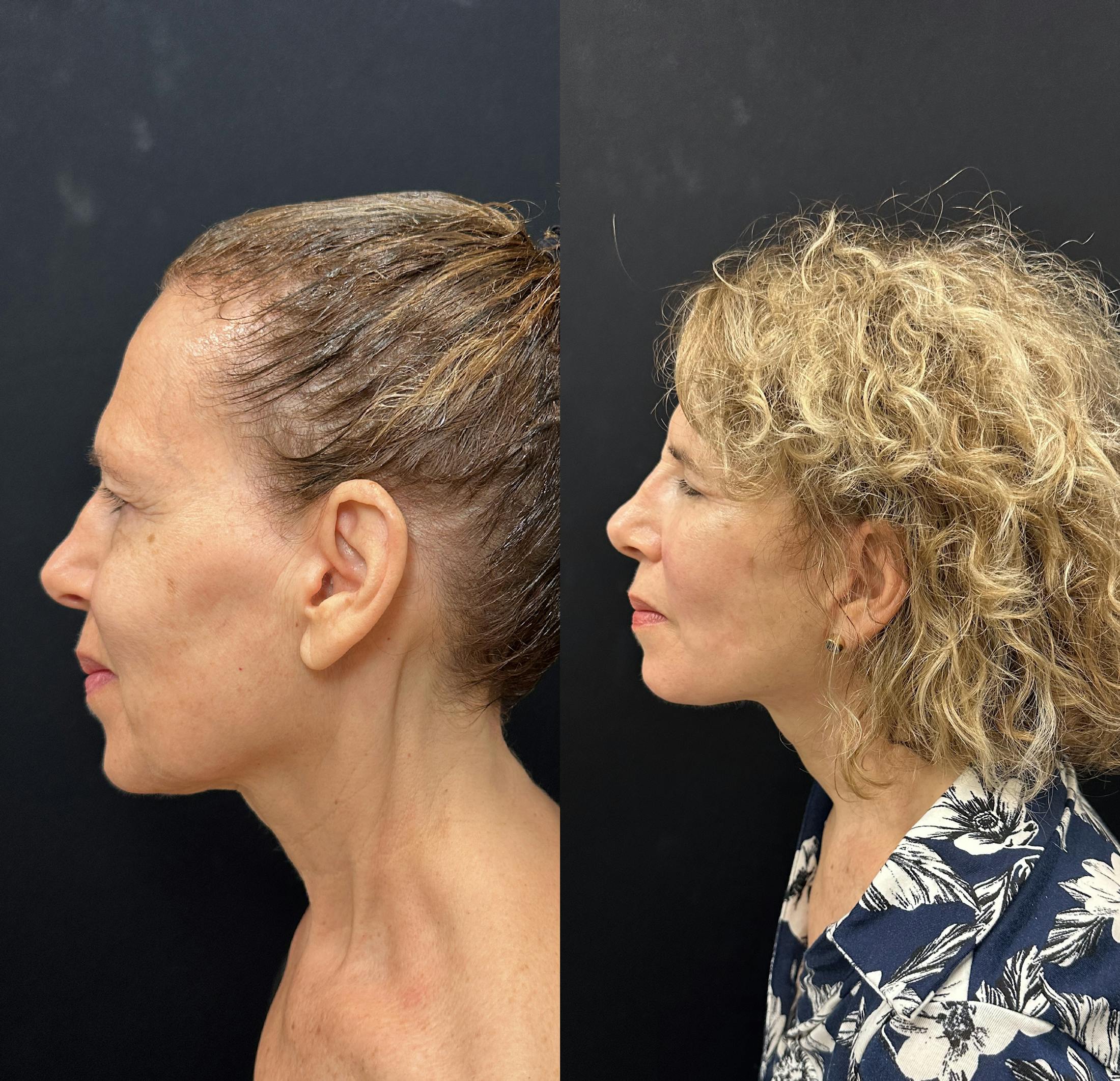 Deep Plane Facelift Before & After Gallery - Patient 392640 - Image 4