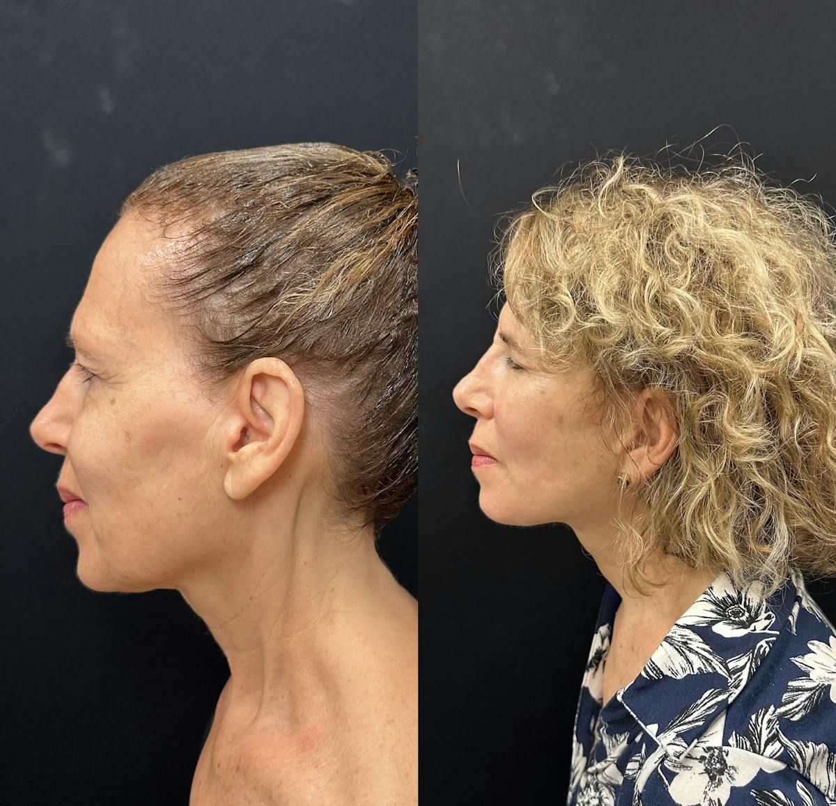 Deep Plane Facelift Before & After Gallery - Patient 392640 - Image 4