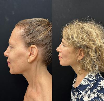 Deep Plane Facelift Before & After Gallery - Patient 392640 - Image 4