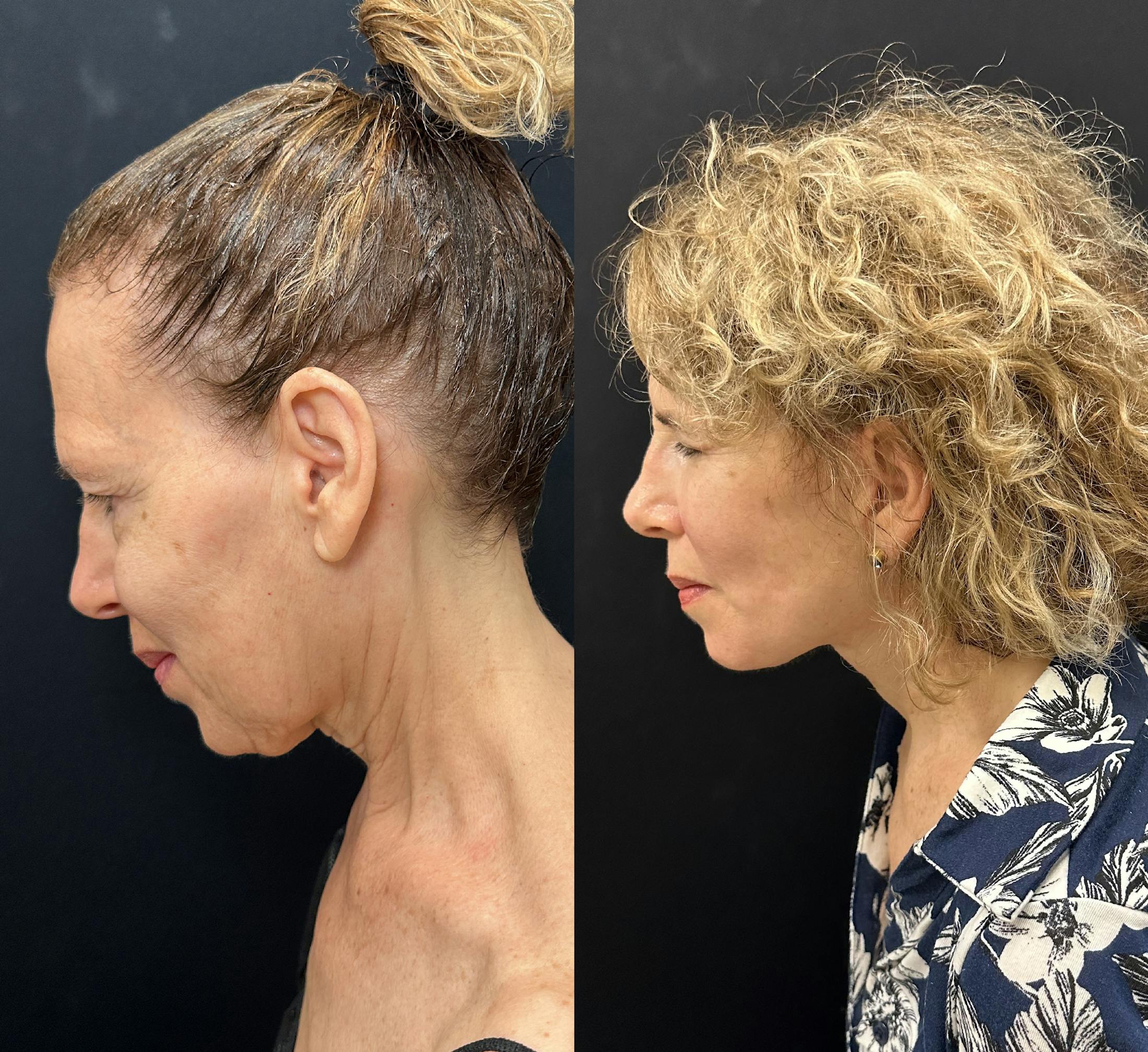 Deep Plane Facelift Before & After Gallery - Patient 392640 - Image 5