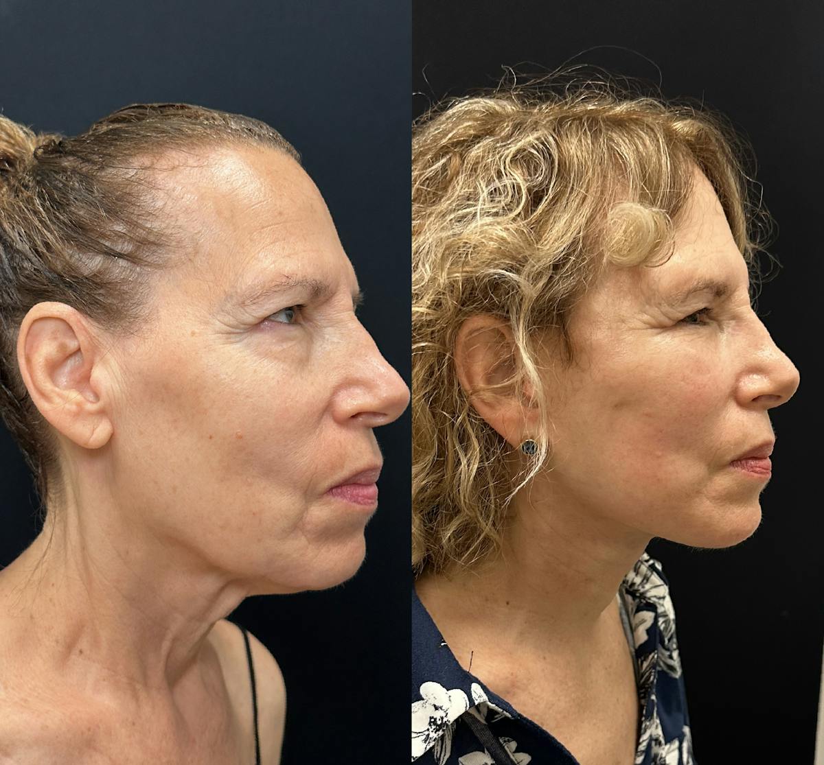 Deep Plane Facelift Before & After Gallery - Patient 392640 - Image 1