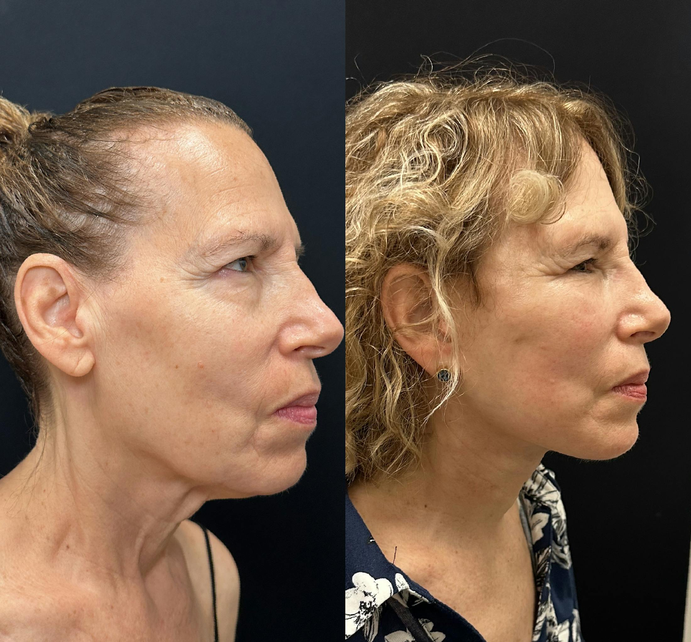 Deep Plane Facelift Before & After Gallery - Patient 392640 - Image 1