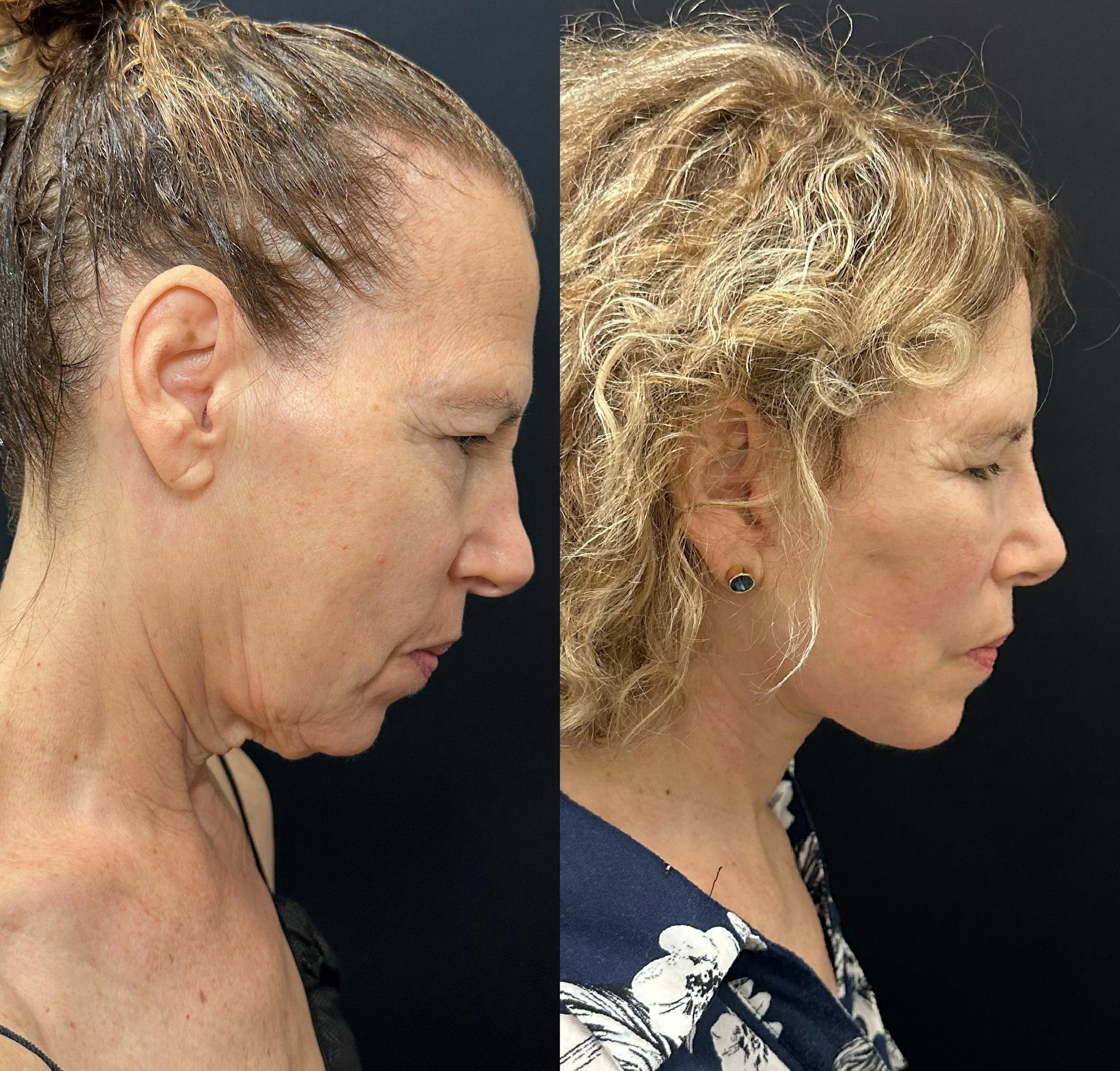 Deep Plane Facelift Before & After Gallery - Patient 392640 - Image 3