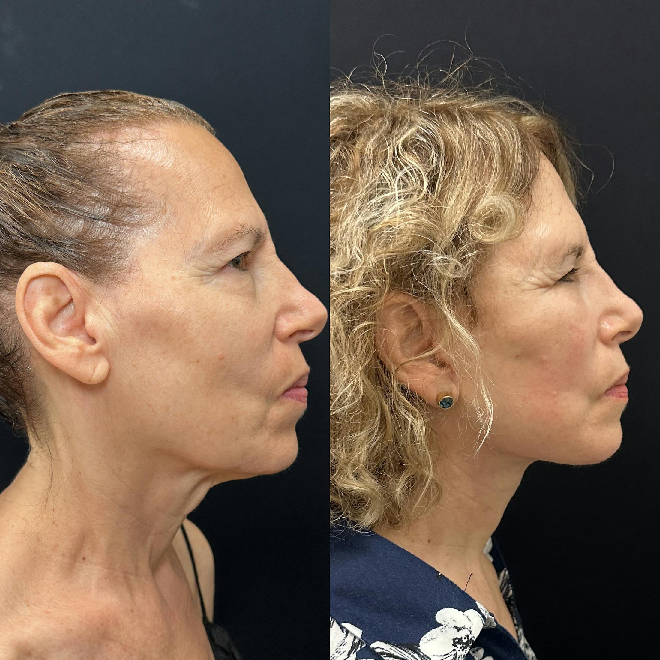 Deep Plane Facelift Before & After Gallery - Patient 392640 - Image 2
