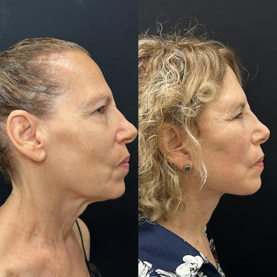 Deep Plane Facelift Before & After Gallery - Patient 392640 - Image 2