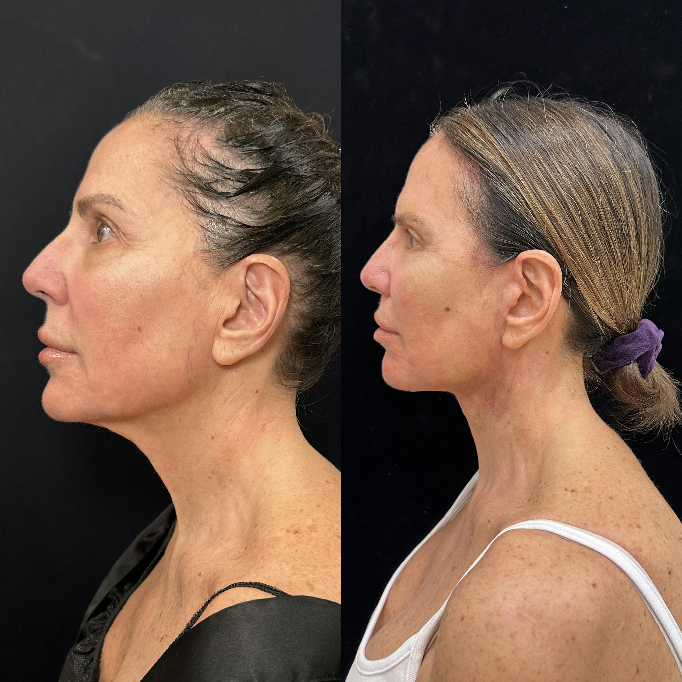 Deep Plane Facelift Before & After Gallery - Patient 275282 - Image 5