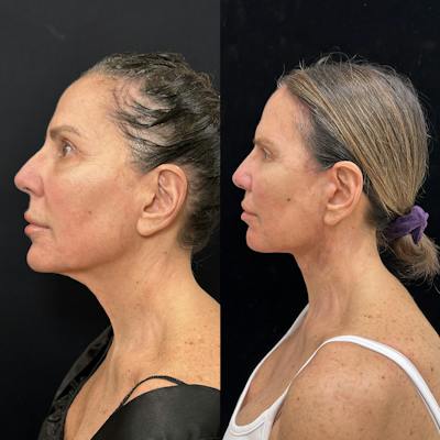 Deep Plane Facelift Before & After Gallery - Patient 275282 - Image 5
