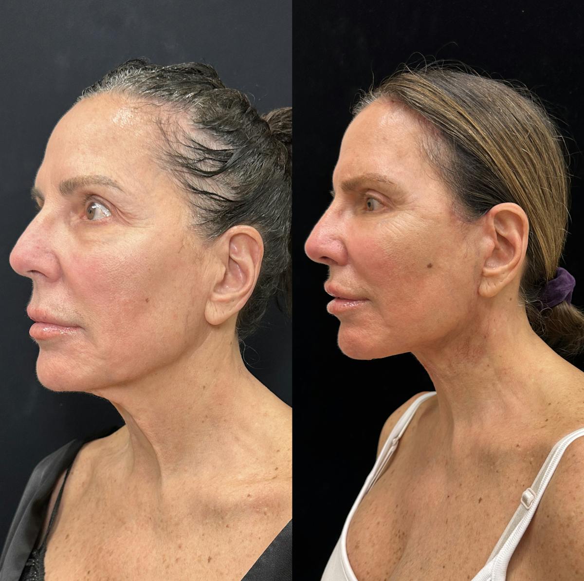 Deep Plane Facelift Before & After Gallery - Patient 275282 - Image 4