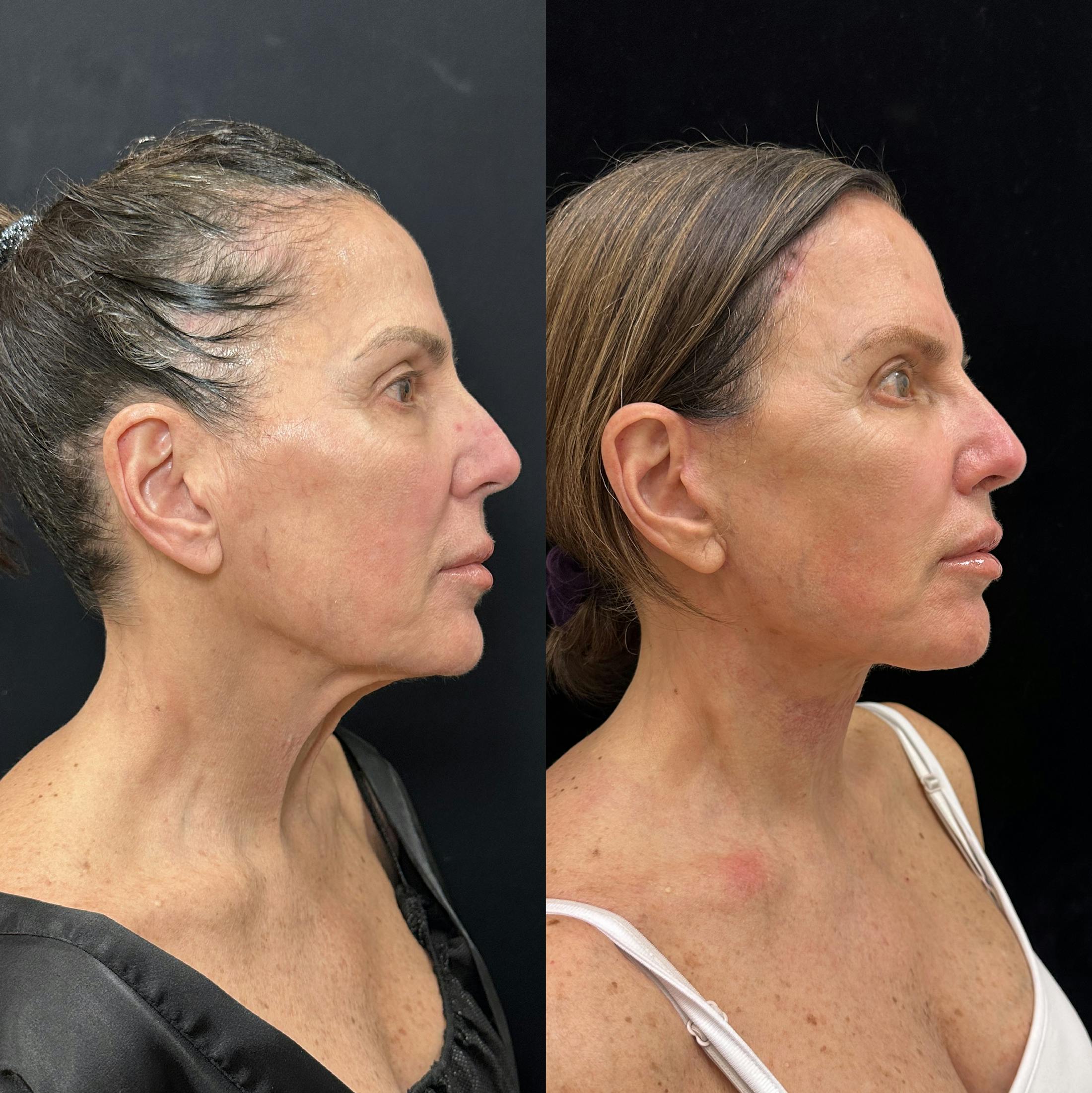 Deep Plane Facelift Before & After Gallery - Patient 275282 - Image 2