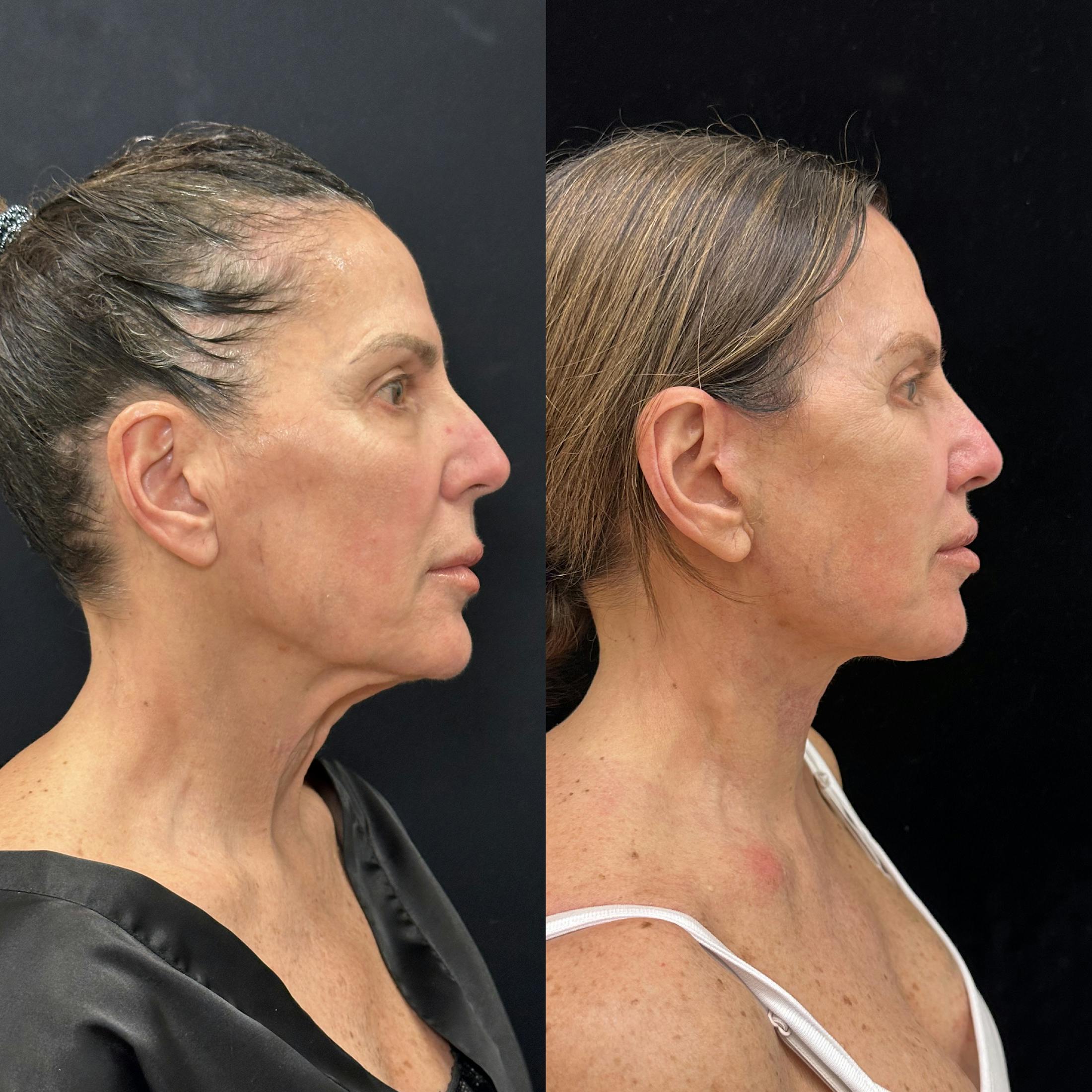Deep Plane Facelift Before & After Gallery - Patient 275282 - Image 3