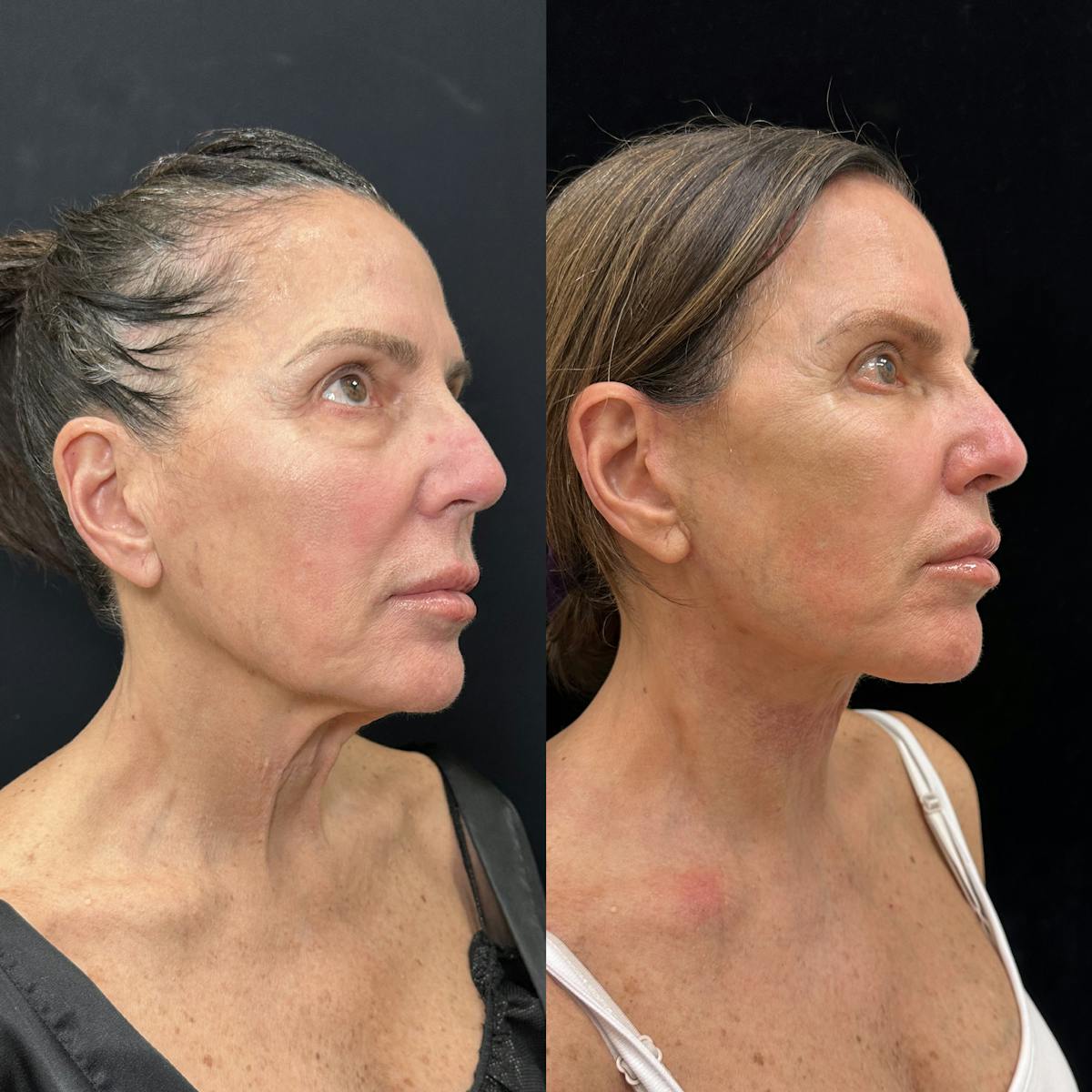 Deep Plane Facelift Before & After Gallery - Patient 275282 - Image 1