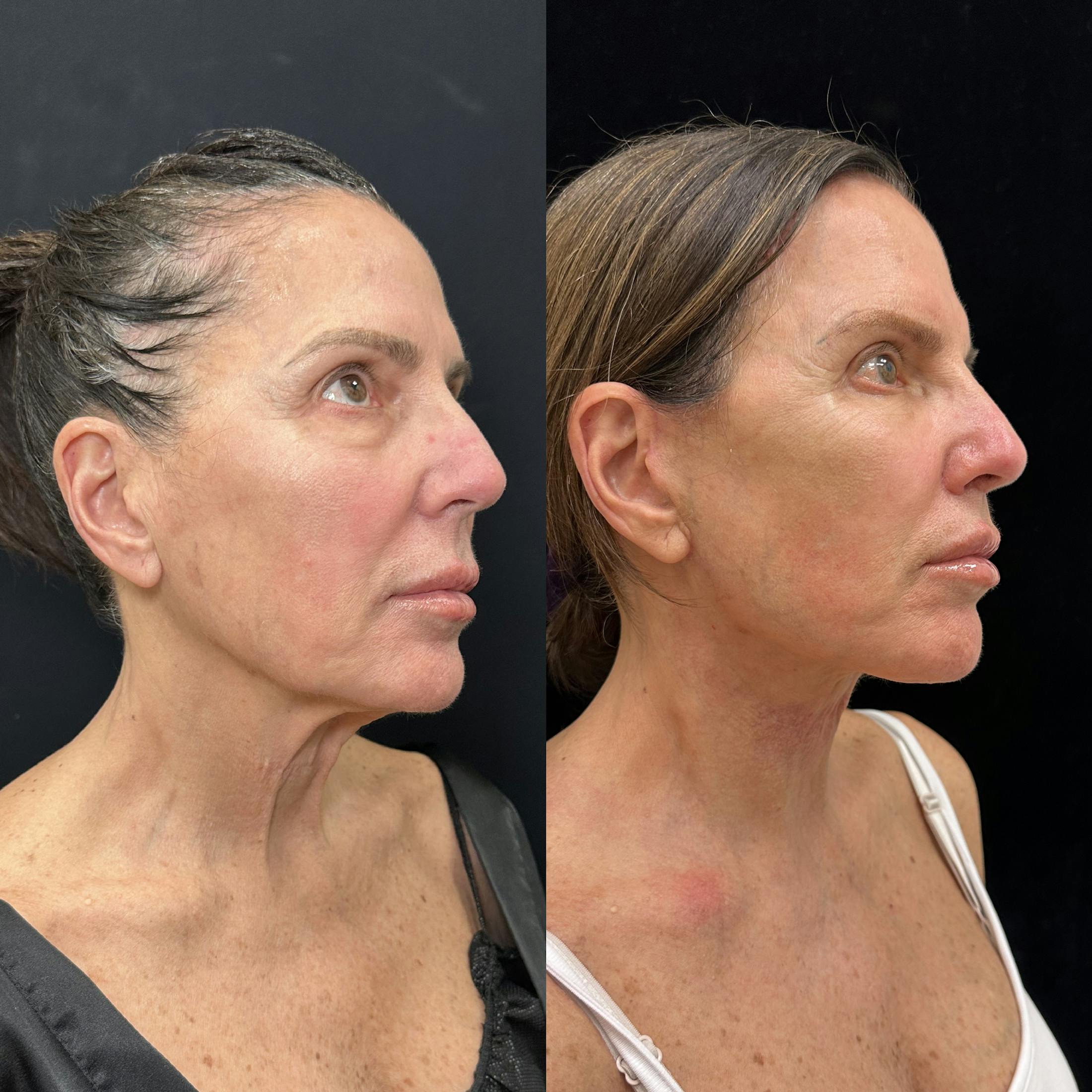 Deep Plane Facelift Before & After Gallery - Patient 275282 - Image 1