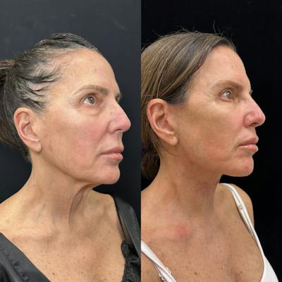 Deep Plane Facelift Before & After Gallery - Patient 275282 - Image 1