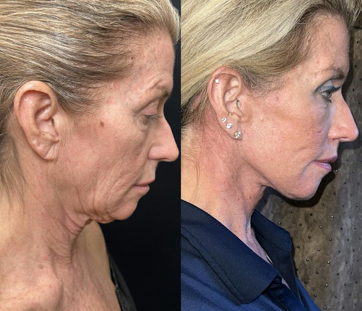 Deep Plane Facelift Before & After Gallery - Patient 407012 - Image 2