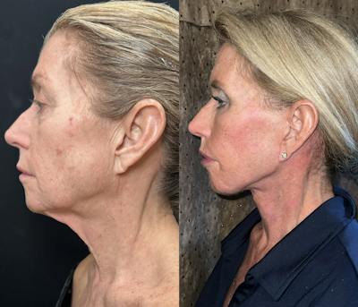 Deep Plane Facelift Before & After Gallery - Patient 407012 - Image 3