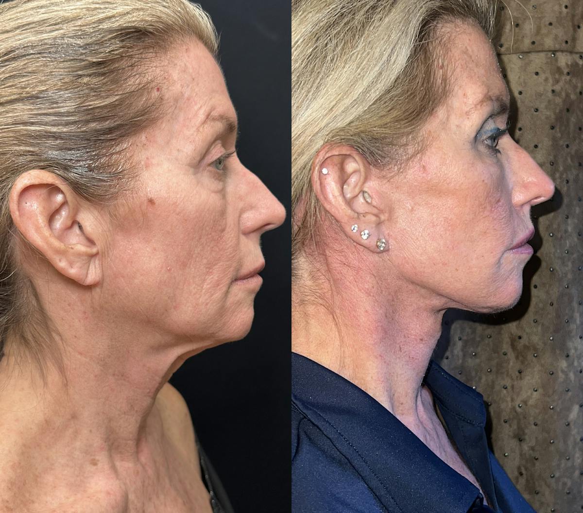 Deep Plane Facelift Before & After Gallery - Patient 407012 - Image 1