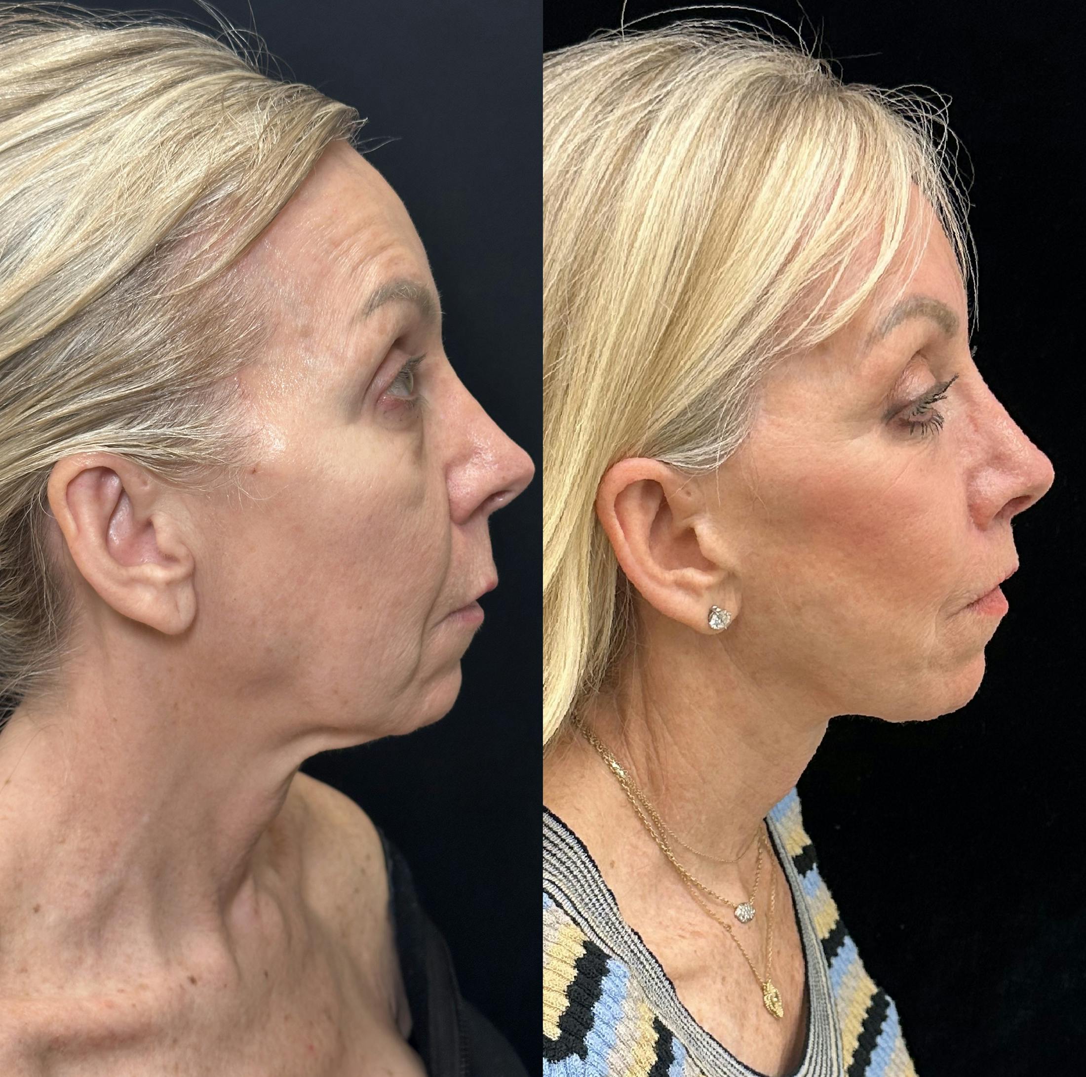 Deep Plane Facelift Before & After Gallery - Patient 533350 - Image 4